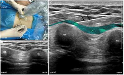 Effect of pecto-intercostal fascial block on extubation time in patients undergoing cardiac surgery: A randomized controlled trial
